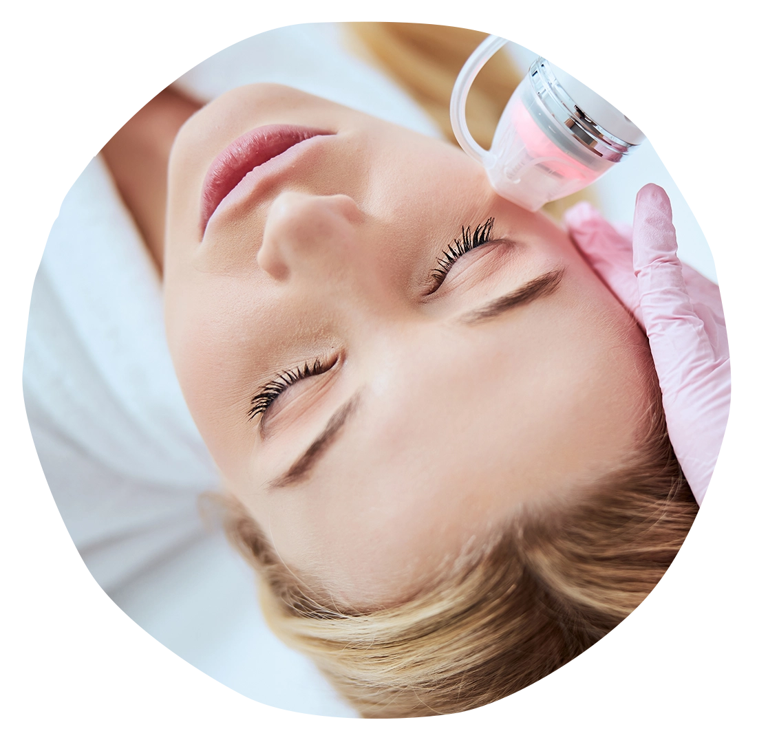 Auswahlbild fuer Microneedling